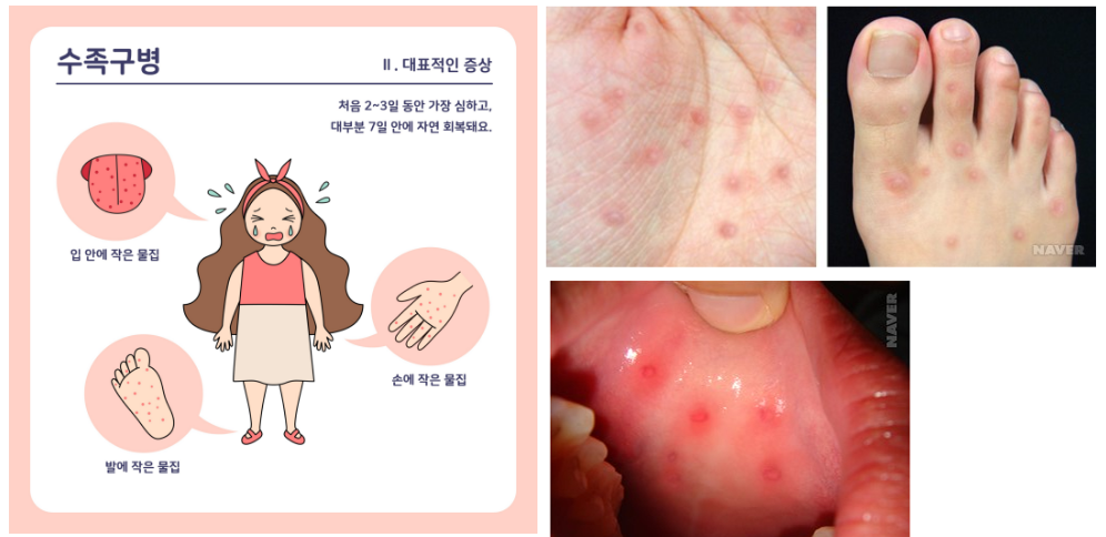 수족구병 증상