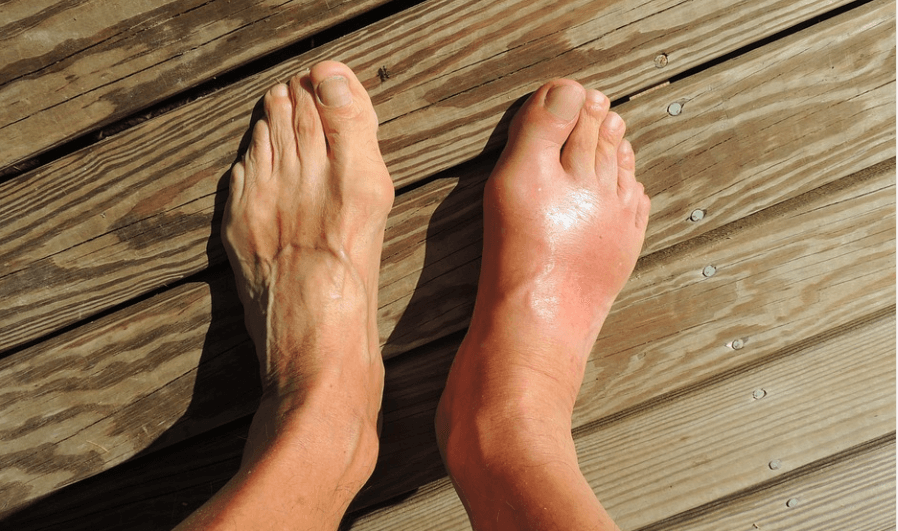 발등이 붓는 이유 - 7