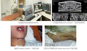 암 방사능 치료