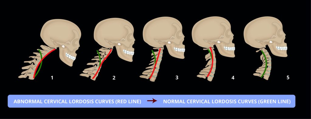 출처 : 출처 https://levelspine.com.au/wp-content/uploads/2023/11/differnt-stages-of-neck-curve-2--1536x591.jpg
