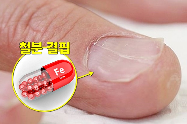 손톱 함몰 들뜸 철분 부족 증상, 갑상선 기능 저하증, 손톱으로 보는 건강상태,건강 팁줌 매일꿀정보