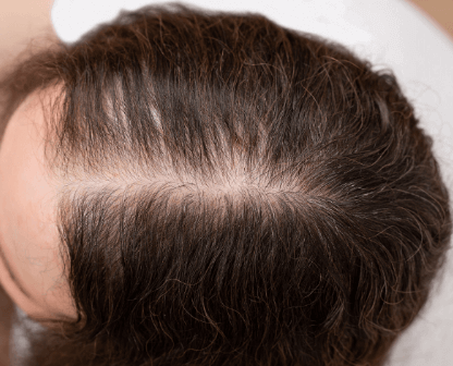 탈모의 원인과 해결방안