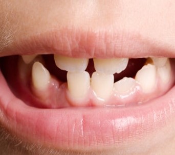 이가-들쭉-날쭉으로-엉망으로-난-모습