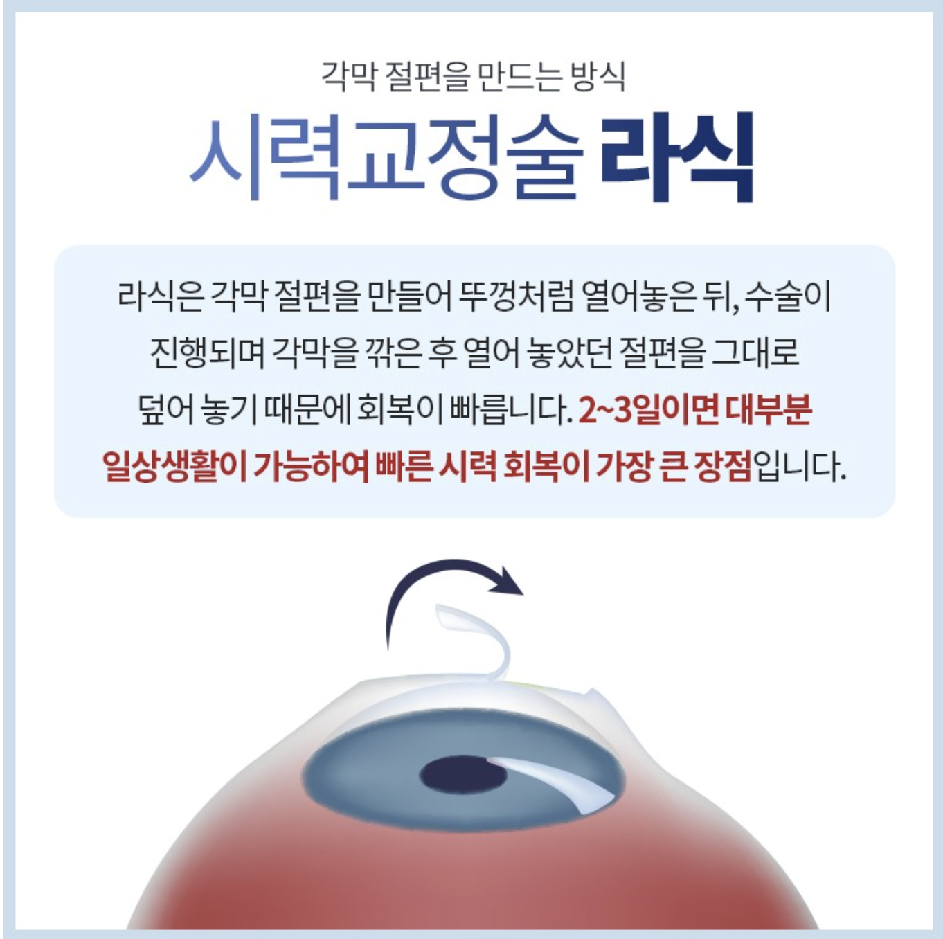 라식-정보-알아보기