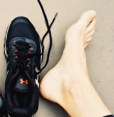 복숭아뼈 주위가 부어요, 단순한 부음일까? 물혹일까?