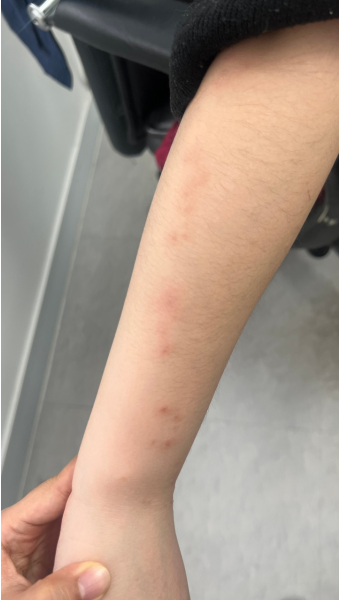 쯔쯔가무시병의 증상과 치료