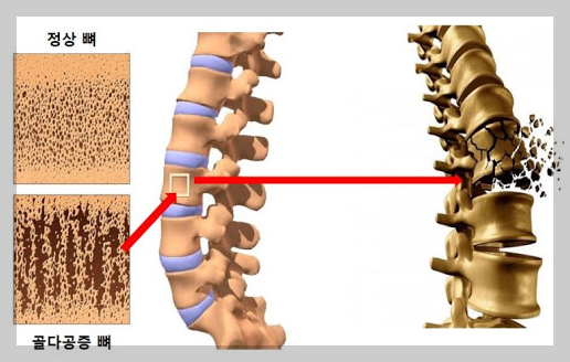 골다공증 검사, 수치분석 및 좋은 음식 영양제 등 5분 정리