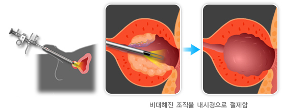 전립선 비대증 약물