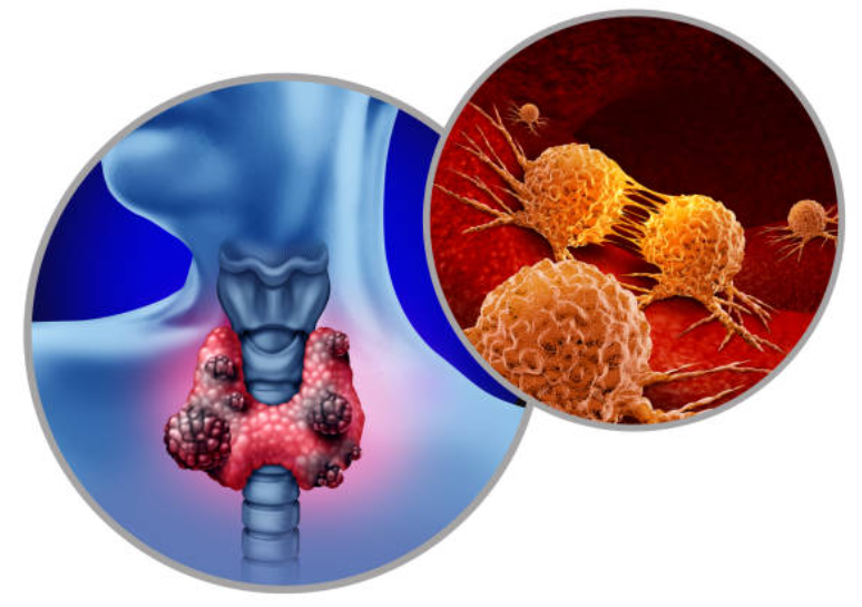 갑상선암과 관련된 사진2