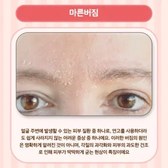 얼굴 버짐 증상 없애는 실전 방법 5가지 및 관리요령_3