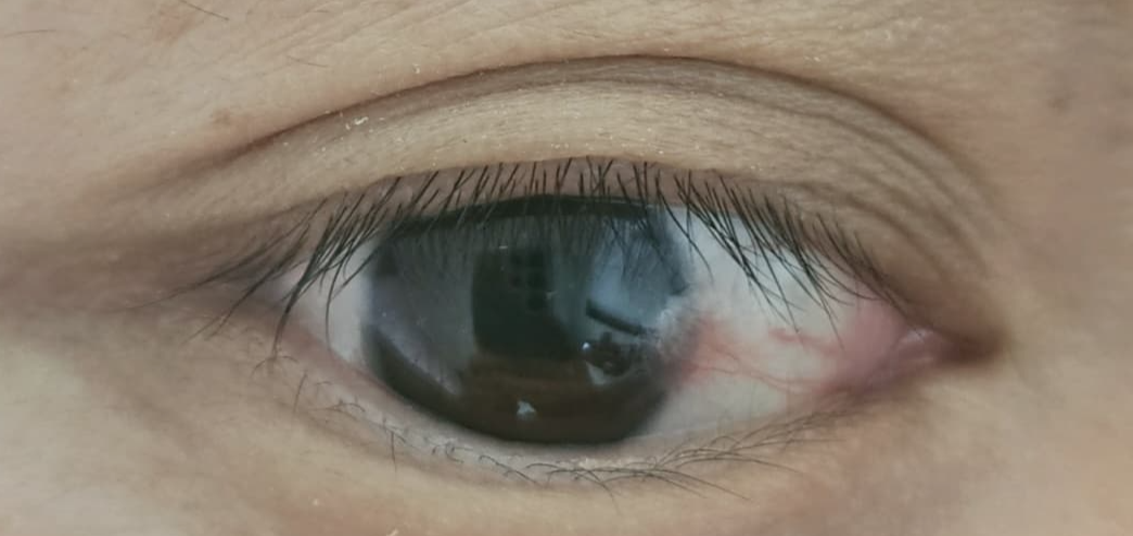 익상편 증상, 치료, 수술, 예방법