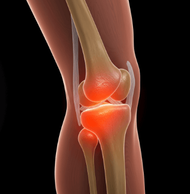 퇴행성관절염 증상 총정리6