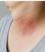 대상포진초기증상