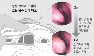 비염 치료방법 4가지만 해보세요.