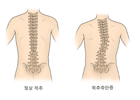 척추측만증이란?