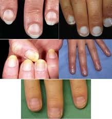 손톱에 세로줄이 생기는 이유