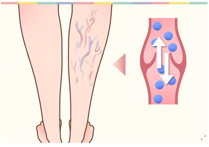 하지정맥류 초기증상과 하지정맥류 치료 병원 