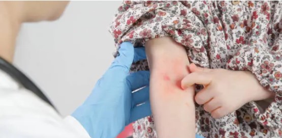 아토피로 고생하는 어린이 사진