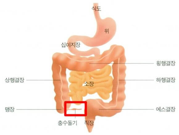 충수염 증상