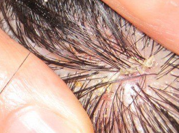 두피 염증 증상