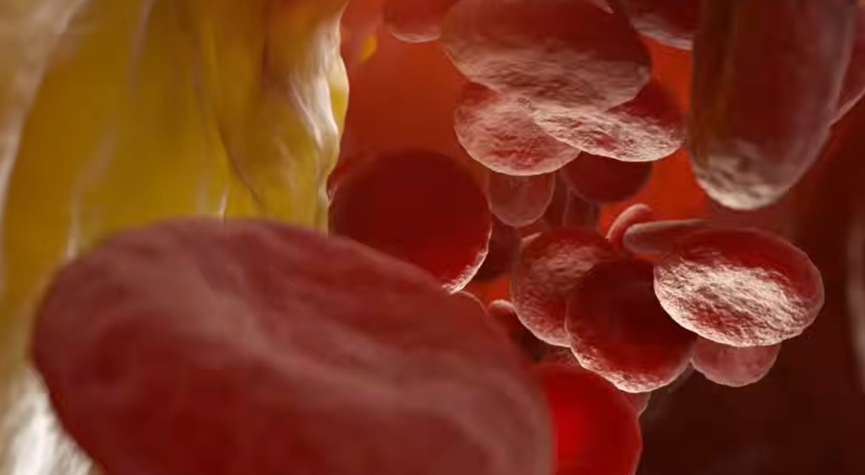 뇌경색 전조증상