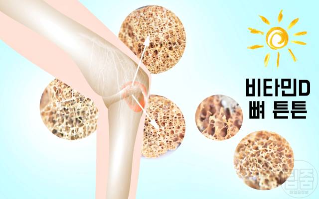 얼굴주름 골다공증 팔자주름 귓볼주름 심장마비