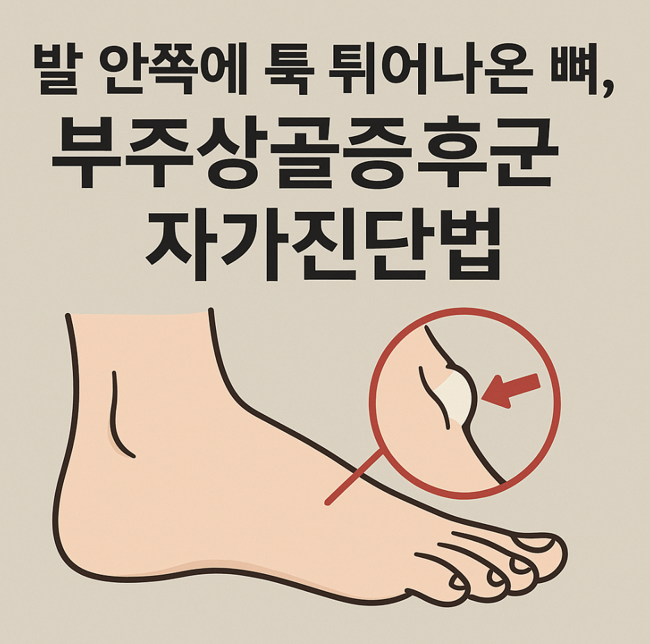 발 안쪽에 툭 튀어나온 뼈, 부주상골증후군 자가진단법