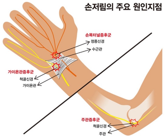 손목 터널 증후군과 팔꿈치 터널 증후군의 차이점