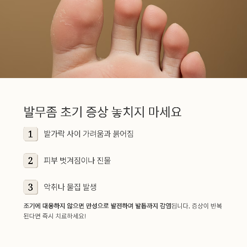땀 많고 습한 여름, 무좀 번식 막는 실전 방어법