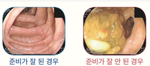 대장내시경 전 음식