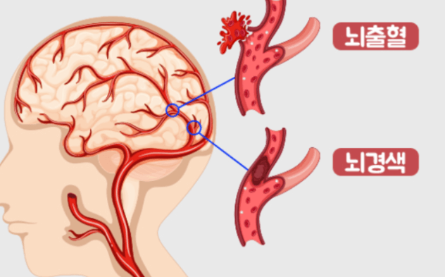 뇌경색과 뇌출혈