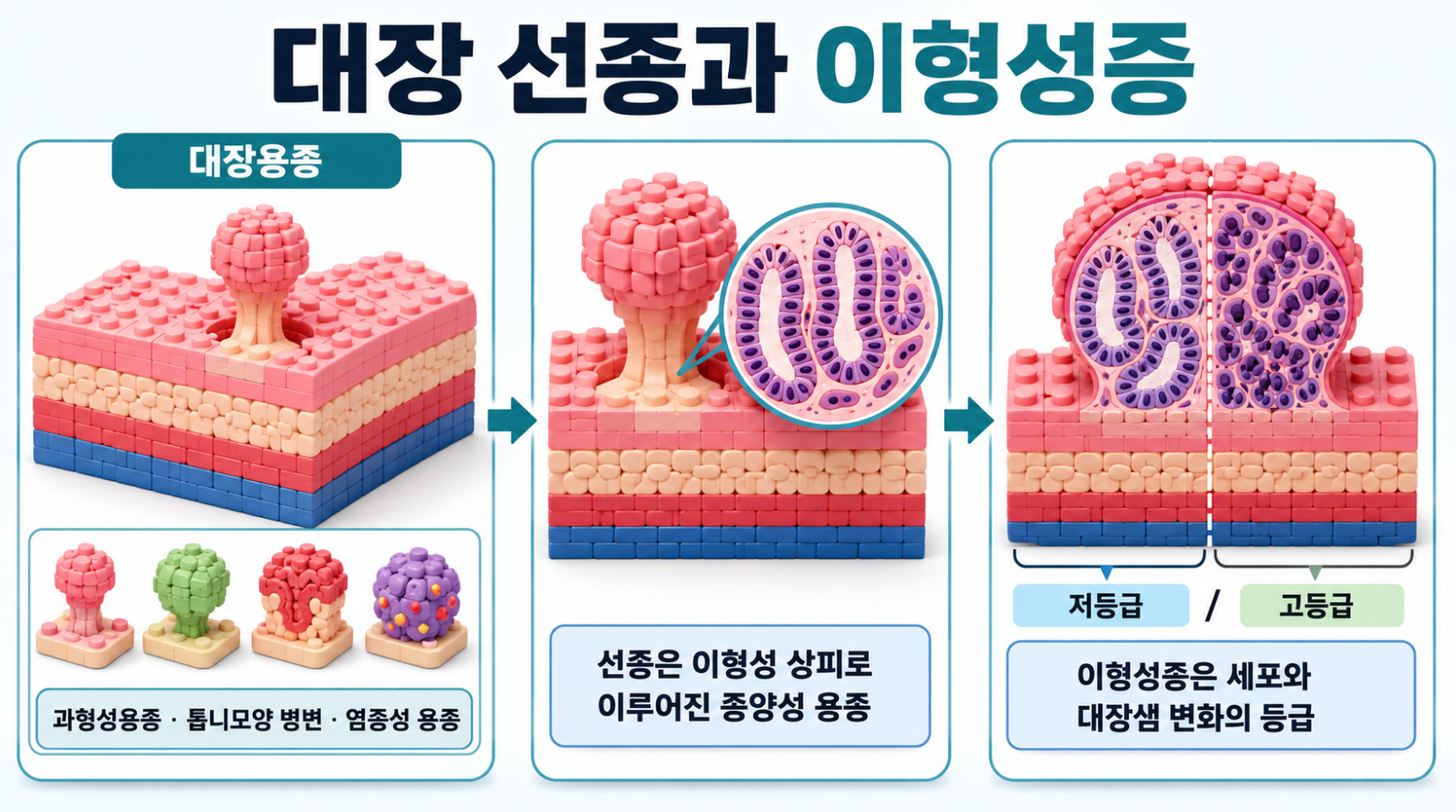 대장용종과 선종의 관계 및 저등급&middot;고등급 이형성증의 의미를 비교한 의료 인포그래픽