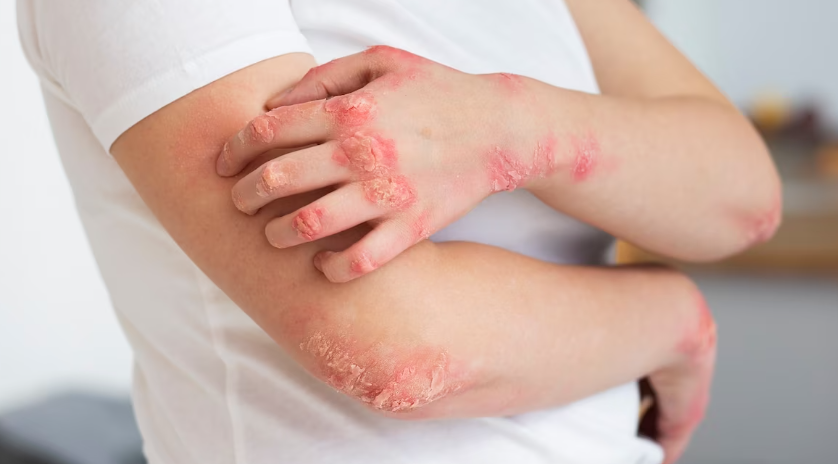 알레르기 반응의 원인