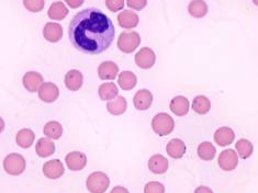 마이코플라즈마 폐렴 해결방법