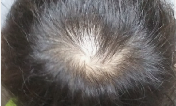 직접 바르는 탈모제 종류와 주의사항 관련 사진