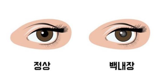 백내장-수술비용