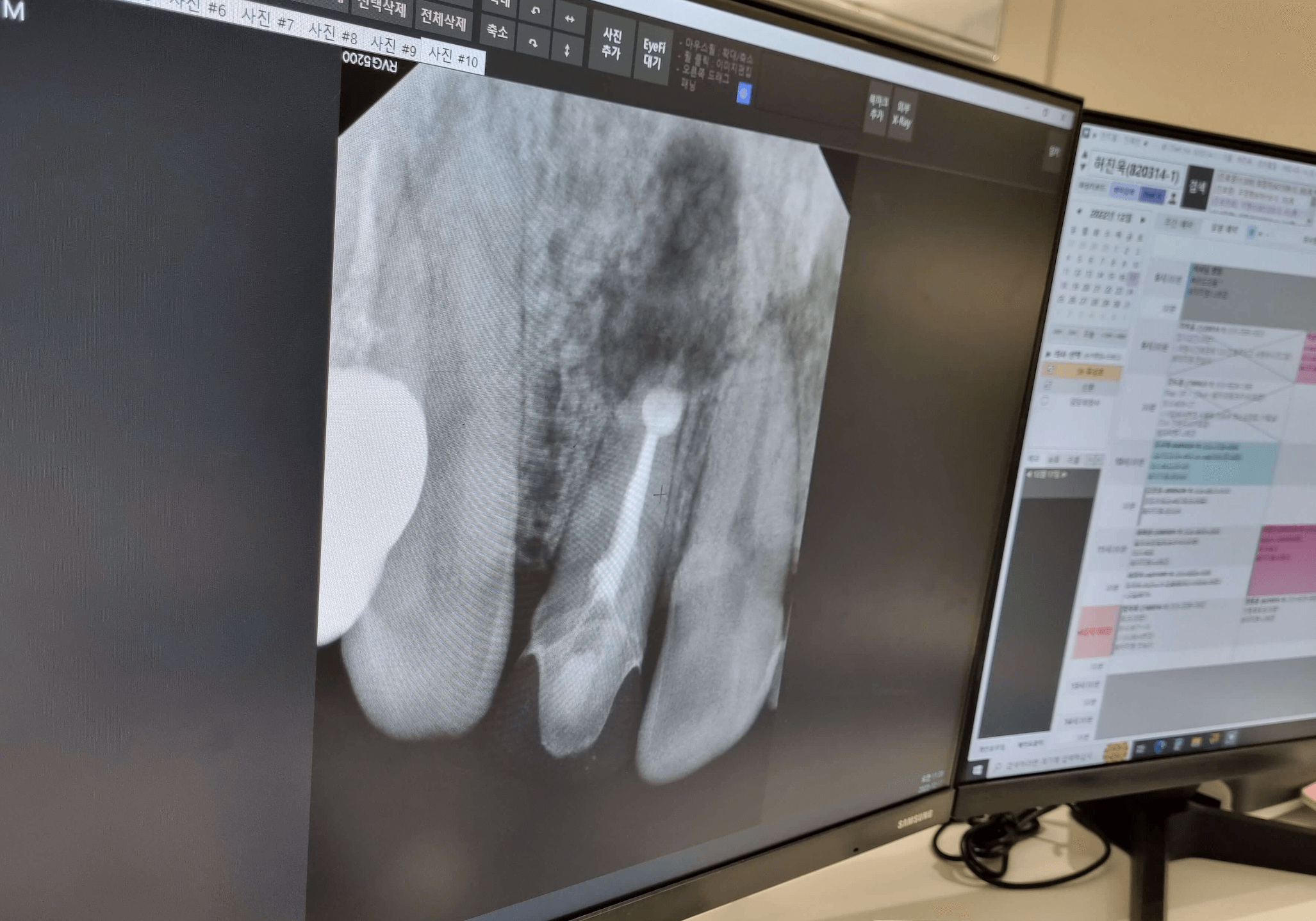 치근단 절제술 뼈이식