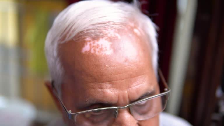 피부색이 달라지는 얼굴 백반증, 치료 가능할까?