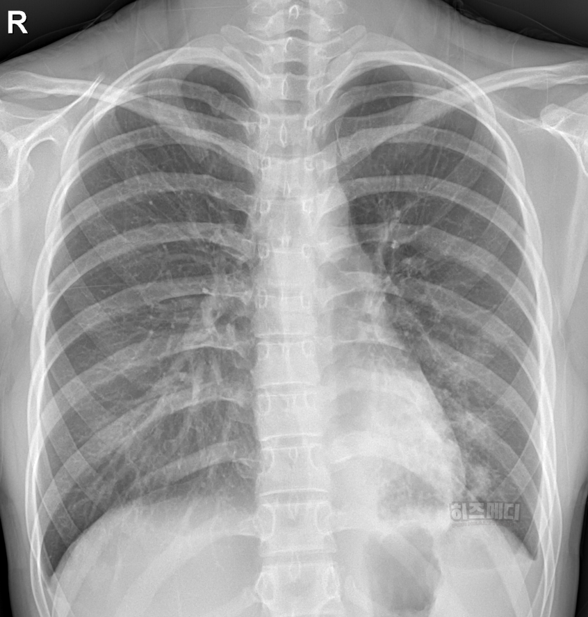 마이코플라스마 폐렴 전염 증상