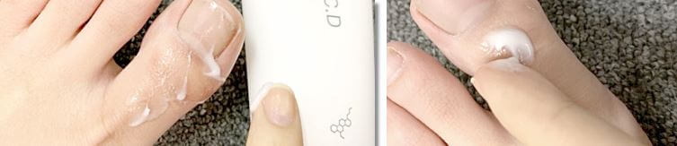 발톱 무좀에 외용제를 바르는 모습