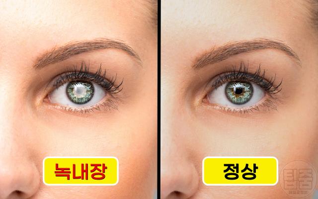 녹내장 잘 걸리는 사람 고위험군 특징