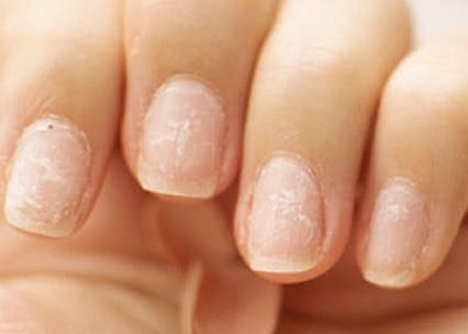 건선이 생긴 손톱