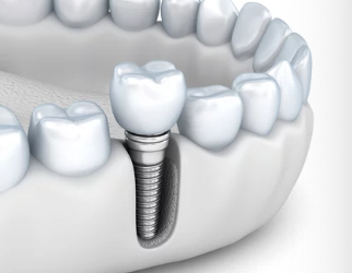 임플란트 모형 사진