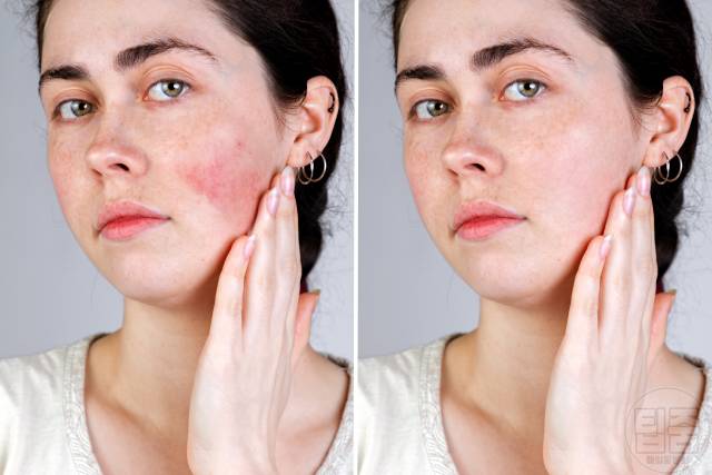 얼굴 붉은기 원인 얼굴 빨개지는 이유 얼굴홍조 원인