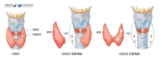 갑상선 절제술 종류 : 갑상선 엽절제술, 갑상선 전절제술