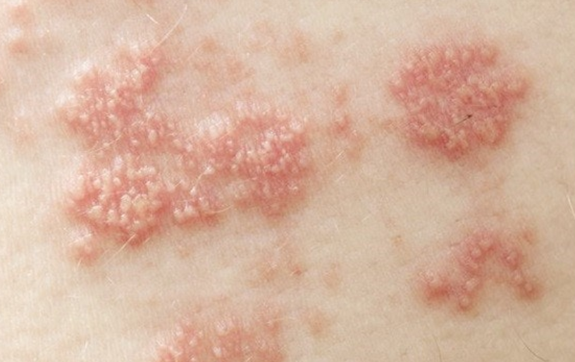 대상포진-초기증상-피부