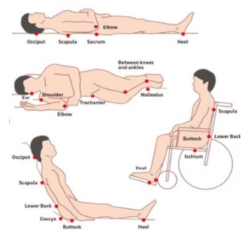욕창 호발부위 간호