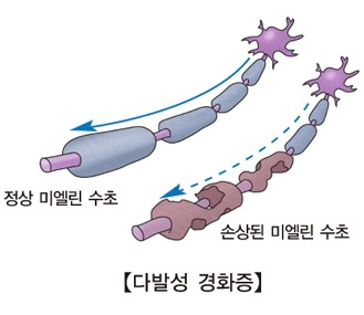 다발성 경화증 증상