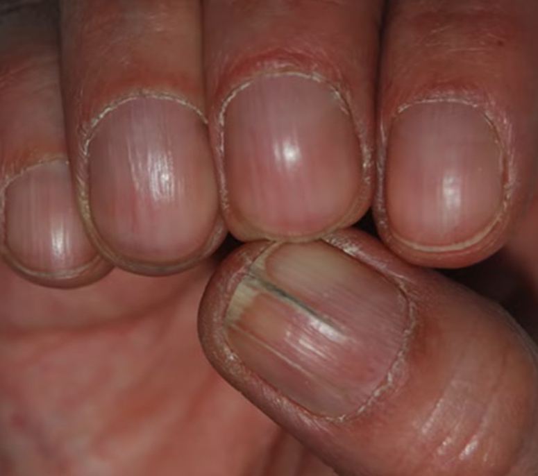 손톱이 잘 부러지는 이유