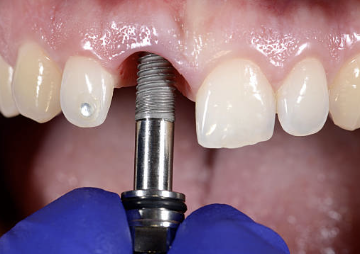 임플란트 시술과정